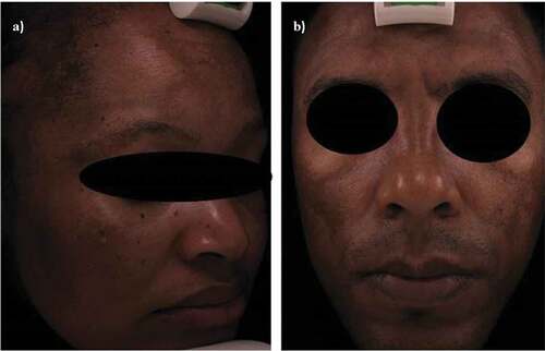 Figure 1. Fitzpatrick skin phototype V with total face involvement melasma. (a) Female full face melasma involvement. (b) Male pattern melasma involving upper mentonian lesions, mandibular, zygomatic, temporal, and frontal (researchers’ collection).