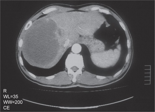 Figure 1 CT scan of the case of HCC spontaneous regression.