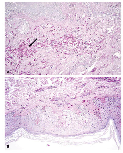 Figure 2 Biopsy of nodular skin lesion at the diagnosis (A) and after treatment (B).