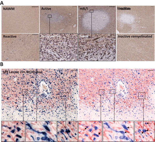 Figure 1. Characterization of postmortem MS white and gray matter lesions. (a) Immunohistochemical staining of formalin-fixed paraffin-embedded postmortem white matter MS tissue for HLA-DR (black) and PLP (brown). Panels show normal-appearing white matter (NAWM; no demyelination, no infiltration of HLA-DR+ cells), reactive site (no demyelination, infiltration of HLA-DR+ cells), active lesion (demyelination, infiltration of HLA-DR+ cells throughout the lesion), mixed active/inactive lesion (mA/I; demyelination, infiltration of HLA-DR+ cells at the lesion rim), inactive lesion (demyelination, no infiltration of HLA-DR+ cells), and inactive remyelinated/shadow plaque (partial demyelination/loose myelin, no infiltration of HLA-DR+ cells). Bar = 500 µM. (b) Double staining for MOG (red) and Iba-1 (blue), showing the original (left) and optimized (right) figures. The arrows show internalized MOG-positive fragments by Iba-1 positive cells, indicating active myelin uptake. Bar = 50 µM.