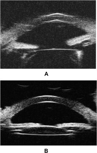Figure 4 Ultrasound biomicroscopy of the (A) right and (B) left eye one year postoperatively.