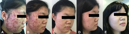 Figure 2 (A) Before treatment. (B) After the end of red and blue light treatment (at second week). (C) After RF treatment (at tenth week). (D) after 2 times of IPL treatments (the 18th week). (E) After 4 times of IPL treatments (the 26th week).