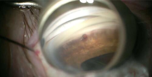 Figure 2 CyPass Micro-Stent positioning within the supraciliary space, entering posterior to the scleral spur, using the approved loading device. This Cypass is fully inserted without rings showing and there is no local corneal edema.