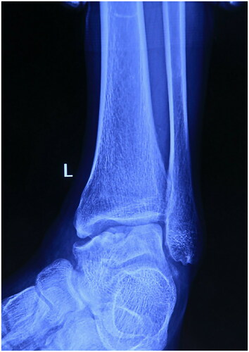 Figure 1. Lateral and anteroposterior x-rays of left ankle showing the necrosis and collapse of medial talus shoulder.