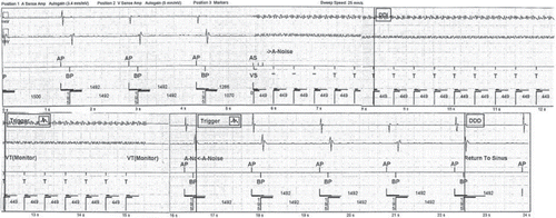 Figure 2. An example of an ICD's false detection of ventricular tachycardia. A sine-wave magnetic field (60 Hz, 410 µT) produced an artefact of ventricular tachycardia and made the ICD to switch to noise mode (DDI). The interference lasted 10 seconds which is equal to the time the magnetic field was applied. The ICD in question was St. Jude Medical's PROMOTE RF 3213-36. DDI is the programmed noise mode of the ICD. Hz is Hertz. ICD is an implantable cardioverter-defibrillator. µT is micro Tesla. s is second.