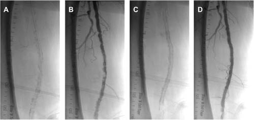 Figure 3 Severely calcified right SFA (A) with severe stenosis in the proximal and middle segment (B) treated with overlapping 5.5×150 mm and 5.5×60 mm Supera stents (C) with no significant residual stenosis (D).