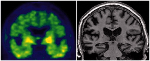 Figure 7. Tau PET and MRI in an A–T + N+ SNAP subject. Clinically normal 81-year-old male participant in the Mayo Clinic Study of Aging. Abnormal Tau PET uptake (AV1451) is present in the medial, basal, lateral temporal lobes bilaterally (left panel). Non-specific AV1451 uptake is present in the basal ganglia bilaterally. This participant also has medial temporal lobe atrophy (right panel) and a normal amyloid PET scan (PIB, not shown). This individual’s ATN profile was A–T + N+.