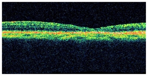 Figure 3 17 hours postoperative – closed hole with restoration of foveal contour.