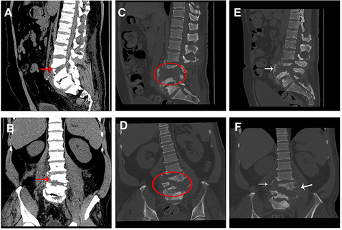 Figure 3 CT images at different time-points. (A) Sagittal CT image at admission; (B) axial CT image at admission; (C) sagittal CT image at 78 days after admission; (D) axial CT image at 78 days after admission; (E) sagittal CT image at re-examination; (F) axial CT image at re-examination. Red arrow indicates slight L3–5 vertebral body destruction with grade I L4 spondylolisthesis. Oval indicates broader and more severe L3–5 damage including grade II L4 spondylolisthesis, L4–5 disc space disappearance and L3–5 vertebral body destruction. White arrow indicates new bone formation.