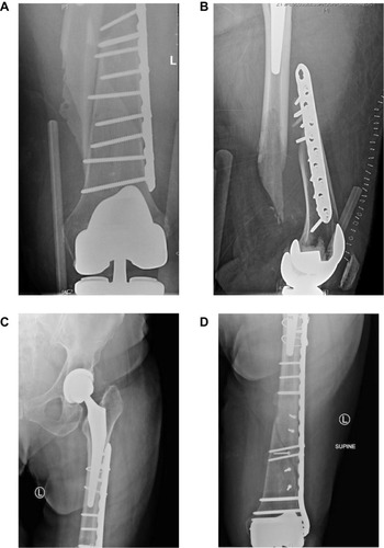 Figure 3 Preoperative anteroposterior (A) and lateral (B) radiographs showing plate osteosynthesis with a lateral locking plate and high screw density and thus stiff construct, resulting in a failure of fixation. Anteroposterior (C, D) radiographs of the revision construct demonstrating interfragmentary screws, decreased screw density and construct stiffness, and appropriate prosthesis overlap.