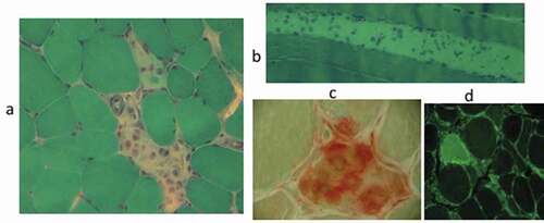 Figure 3. Main histopathological features of Necrotizing Autoimmune Myositis characterized by necrotic fibers (a, b) invaded by macrophages (c), that exhibit spotty MHC-I expression (d) [modified from [Citation1]].