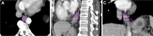 Figure 1 An example of the contours delineated in the image sessions in transversal (A), sagittal (B), and coronal section (C).