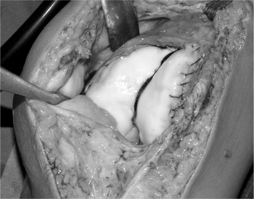 Figure 2. Intraoperative finding after trochleaplasty with the deeper trochlear groove. The trochlear cartilage is fixed with 2 transosseous vicryl strings. The synovia is reattached with continuous absorbable braided 2-0 suture to the condylar edges.