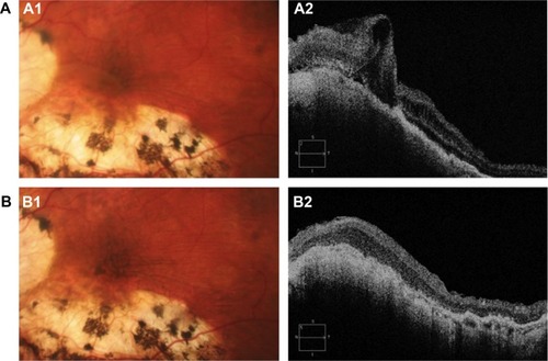 Figure 1 (A) Preoperative hypotony maculopathy shown by posterior pole biomicroscopy (A1) and by optical coherence tomography (A2) in case 1. (B) Biomicroscopy (B1) and optical coherence tomography obtained one year after vitreoretinal surgery (B2) in case 1. Note the increase of hyperpigmentation (B1) despite resolution of the retinal folds, but not the choroidal folds (B2) in case 1.