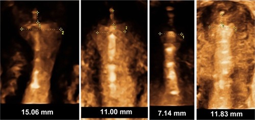 Figure 12 3-D ultrasound of GyneFix, illustrating the compatibility of the frameless intrauterine device with very narrow uterine cavities of young adolescent and nulliparous women.