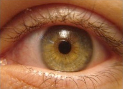 Figure 2 Illustrative example of final ocular surface appearance 3 months after pterigyum removal and autologous conjuntival graft. No recurrence.