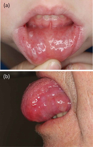 Figure 5. Mucosal involvement. (a) Blisters and erosions on the lower lip of a 6-year old boy (same patient as in Figure 3(a). (b) Erosions on the tongue of a 76-year old male with EBA (same patient as in Figure 4(a,b)