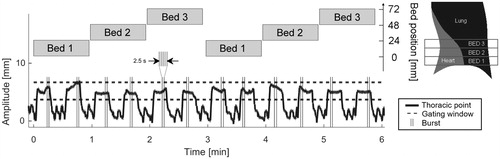 Figure 2. Typical data acquisition pattern during one setup (patient 2, CT2). The amplitude of the thoracic surface point (black) is shown together with start and stop times for the 12 bursts (gray vertical lines). Each burst contained five exposures and the start time of each burst was randomly chosen within each DIBH period. Three different couch (bed) positions were imaged.