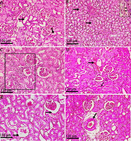 Figure 4. Histopathological view of rat renal sections in the GEN-treated group stained with hamatoxylin and eosin (magnification ×100). (A) Desquamation, degeneration, and vacuolization of proximal tubules (arrows); (B) huge numbers of hyaline casts in renal tubules (thick arrows) and marginal localization of chromatin in the nuclei (inset – thin arrows); (C) mononuclear cell infiltration (rectangled); (D) intertubular haemorrhage (blood filled spaces – thick arrow) and picnosis (thin arrow); (E) atrophied glomeruli (arrows); and (F) obliterative arteriolopathy.