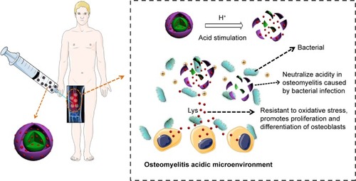 Scheme 2 Illustration of antibacterial, injectable, and pH sensitive Lys@CaCO3 MSs used for potentially minimally invasive treatment of osteomyelitis.Notes: CaCO3 is indicated with purple for the shell and green for the core. Red indicates Lys.Abbreviations: Lys, L-lysine; MSs, microspheres.