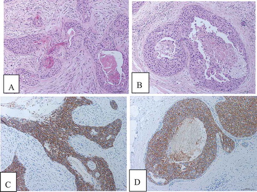 Figure 4. Microscopic features and immunohistochemistry of case 2. (a) Squamous cell carcinoma showed invasive growth. (b) A small amount of intraductal carcinoma. (c) HER2 immunohistochemical staining showed strong continuous expression in the cell membrane of invasive carcinoma with a score of 3+. (d) HER2 immunohistochemical staining showed strong continuous expression in the cell membrane of intraductal carcinoma with a score of 3+