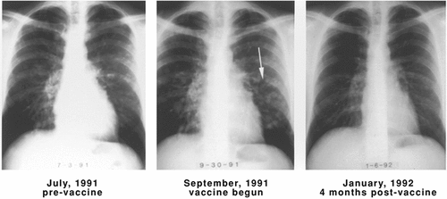 Figure 4. Regression of lung metastases in patient #20063 after administration of DNP-modified, autologous vaccine. Multiple lung metastases are seen in July 1991, most prominently in the left lower lobe, which increased in size and number in the September 1991 X-ray. Four months after beginning DNP-vaccine treatment (January 1992), the metastases had completely regressed. Reprinted fromCitation40 with permission.