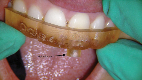 Figure 4. Splint for guided access. Arrow points to guide for bur. Picture courtesy of Dr. David Kelliny.