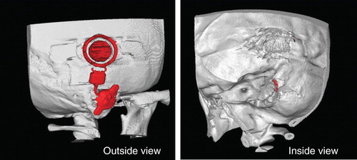 Figure 4. 3D-CT scan images after operation. The Bonebridge (BB) was fixed well on the simulated area without any problem. By inside view, a small part of the bone conduction-floating mass transducer (BC-FMT) was exposed as expected from the simulation to the sigmoid sinus.