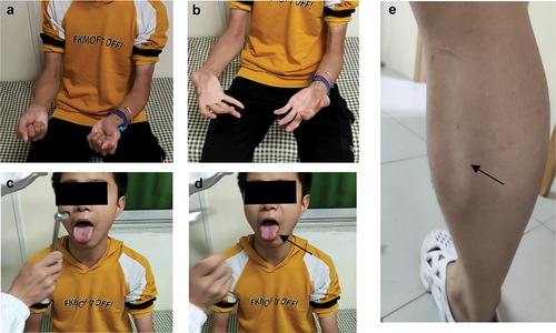 Figure 2. Illustrations about myotonia in case 1. Griping myotonia (a and b); percussion myotonia on tongue muscle (d and d) and gastrocnemius muscle (e).