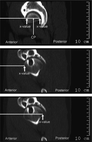 Figure 9. a) The x-value (in the system of co-ordinates) for the anterior edge and the posterior edge of the femoral head on the central slice was noted after which the diameter and the central point of the femoral head could be determined. b and c) The central point of the femoral head is defined at the position presented in Figure 9a with an exact x-value on all images. On the following sagittal images, the x-value for the projected acetabular margin on the femoral head anteriorly and posteriorly was noted, and the horizontal distance to these two points was measured. This patient has large cysts in the acetabulum and one in the femoral head and has osteoarthritis degree 2.