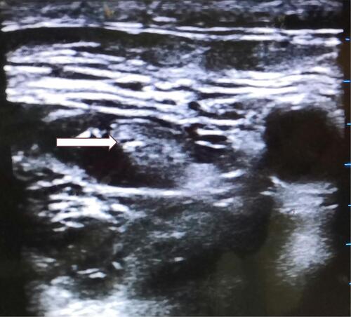 Figure 1 Femoral nerve blocking guided by ultrasound. Arrow indicates the femoral nerve, which is surrounded by injected ropivacaine.