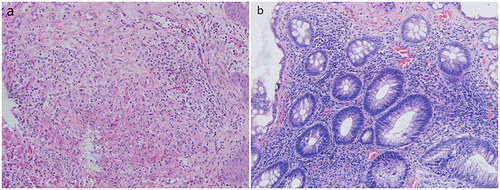 Figure 2 (a and b) Biopsy from the ulcer edge in the skin and transverse colon revealing the infection and granulomatous inflammation (H&E, 100x magnification).