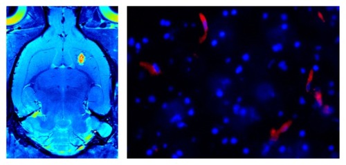 Figure 5 Multimodal imaging of a theranostic agent.Notes: A color-coded in vivo magnetic resonance image of a rat brain, where the agent is indicated as a hyperintense area (shown on the left). An ex vivo fluorescence microscopic image of the brain tissue of the animal, indicating presence of the theranostic agent (red fluorescence) in the cytoplasm of some neurons but not in all (cellular nuclei are stained in blue), is shown on the right. (Images were obtained at our laboratories in Santiago de Compostela).