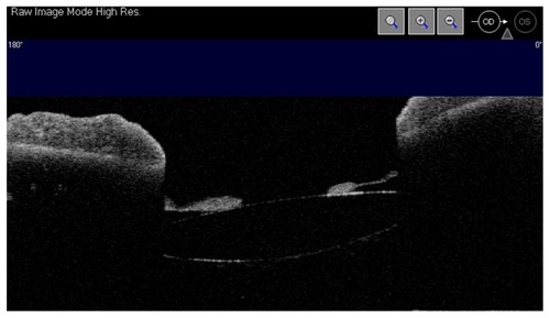 Figure 3 AS-OCT image is unable to show a split capsule in the patient’s eye.
