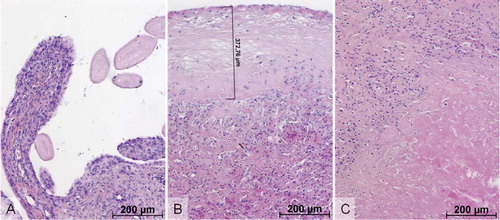 Figure 1. Synovial tissue necrobiosis. (A) Villous proliferations without stainable synoviocytes, blood vessel walls, stromal cells, and inflammatory infiltrates (at top right) were characteristic of villous necrobiosis. (B) Band-like acellular areas of the synovial surface (upper half) showing scattered ghost cells were a typical finding in synovial surface necrobiosis. Their maximal extent vertically was measured digitally and recorded in each case. (C) Similar acellular areas (at lower right) in deeper periarticular soft tissue without any contact with the synovial surface in this specimen were referred to as deep necrobiosis. (Hematoxylin and eosin).