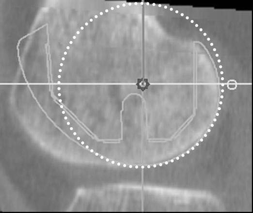 Figure 3. Virtual implantation of the femoral component. The implant size was selected according to the radius (shown as a circle) that was closest to the distance between the TEA (the center of the two orthogonal axes in this view) and the distal condyle border in the lateral condyle.