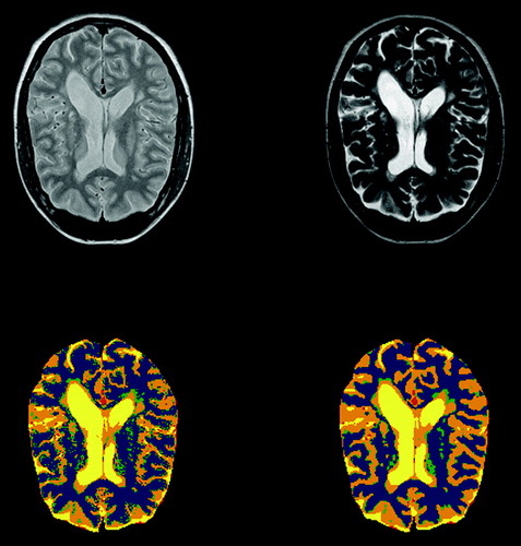 Figure 4.  On top, T2 and proton density images of an MS patient. The lower images show segmentation without and with postprocessing with Hasletts method.