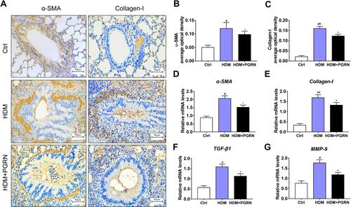 Figure 2 PGRN restrains HDM-induced collagen synthesis and fibrosis in mice. (A) Protein expression of α-SMA and collagen-I in mice was detected by immunohistochemical staining. (B and C) α-SMA and collagen-I expression levels according to average optical density. The relative mRNA expression of fibrosis-related genes including α-SMA (D), collagen-I (E), TGF-β1 (F), MMP-9 (G) were measured by qRT-PCR. For immunochemistry assay, results are obtained from 5 random areas of each sample. Data are expressed as means ± SEMs of three independent experiments with four mice per group. #p<0.05 vs control group, ##p<0.01 vs control group, *p<0.05 vs HDM group.