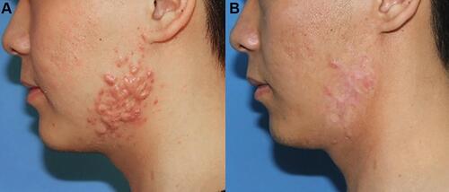 Figure 2 A patient with multiple lesions of keloids on his face prior to treatment (A) and 1 year after PSR treatment with 2 radiation therapy thereafter (B). No recurrence was found.