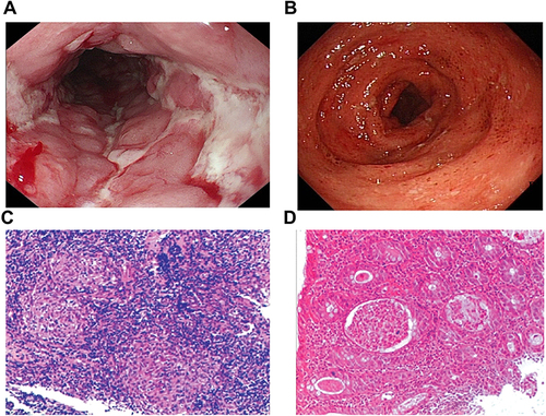 Figure 2 Endoscopic and pathologic features of IBD. (A and C) Endoscopic (A) and histopathologic (C) appearance of Crohn’s disease. (B and D) Endoscopic (B) and histopathologic (D) appearance of ulcerative colitis. Magnification of C and D x 100.
