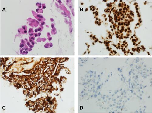 Figure 1 (A) Microscopic appearance of the tumor characterized by solid sheets of highly atypical cells (H&E ×600). (B) Immunohistochemistry stain against TTF-1 shows strong nuclear positivity (immunohistochemistry ×400). (C) Immunohistochemistry stain against napsin-A shows strong cytoplasmic positivity (immunohistochemistry ×400). (D) Immunohistochemistry stain against PD- L1 shows a negative staining (immunohistochemistry ×400).