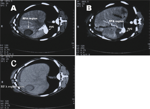 Figure 2. CT scans after RFA. (A) Enhanced CT scans show that the RFA region away from the IVC is round; (B) The RFA region near the IVC shows that the treatment region is more clearly defined as an irregular long strip. No thrombus or ruptures were observed along the IVC; (C) A hypodense area was present in the surrounding area after RFA.
