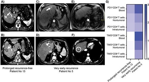 Figure 3 Imaging and immunological profiles of representative patients. (A) Arterial phase axial abdominal CT scan in a 73-year-old man (patient No 13) shows a single 28-mm right liver HCC (white arrow) with peripheral perfusional disturbances at baseline. (B) Arterial phase axial abdominal CT scan of the same patient 45 months after percutaneous thermal ablation shows the ablated area (white arrowhead) without any recurrence. (C) and (E) Arterial phase axial abdominal MRI in a 66-year-old man (patient No 5) shows a single 18-mm left liver HCC (white arrow) at baseline. (D and F) Arterial phase axial abdominal CT scan in the same patient 9 months after percutaneous thermal ablation shows no recurrence at the ablated area (white arrowhead) but a very early intrahepatic distant recurrence in segment VIII (white circle). (G) Immunological profiles of patients No 13 and 5 at baseline. Results are expressed as a heat map-based frequency of positive cells compared with the mean frequency of a corresponding subpopulation of cells of the entire cohort; higher than the mean in dark blue.