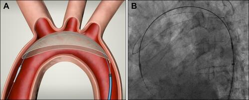 Figure 1 CEP device. (A) Positioned in the aortic arch providing full coverage of all three major aortic branches. (B) A fluoroscopic image of the device.