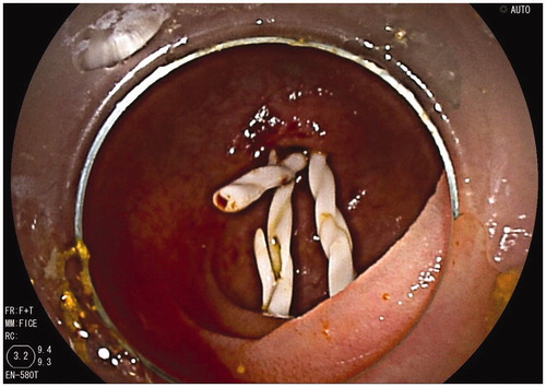 Figure 6. The endoscopy view of Archimedes stents of patient with hepaticojejunostomy anastomotic stricture (number 3).