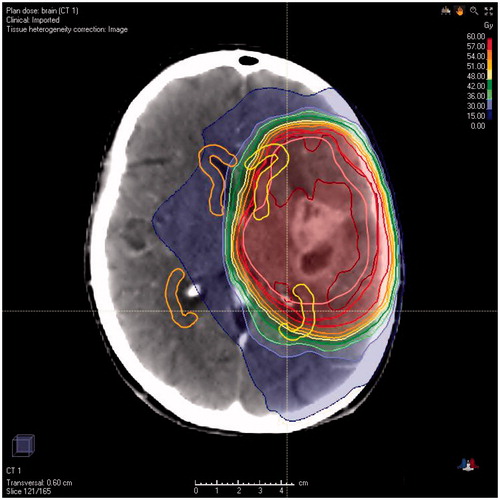 Figure 2. Representative illustration of two-dimension segmentation of the ipsilateral (yellow) and contralateral (orange) subventricular zone on radiotherapy planning CT imaging.