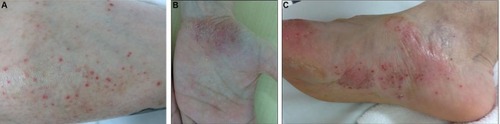 Figure 1 (A) Acne in right lower limb, which spread to patient’s face, limbs, and trunk; (B, C) palmoplantar pustulosis.