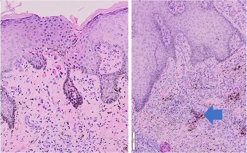 Figure 2 Histopathological findings (Hematoxylin and eosin; x100 and x200 magnifications) showed epidermal acanthosis, dermal fibrosis, and thickening, hemosiderin deposits (blue arrow).