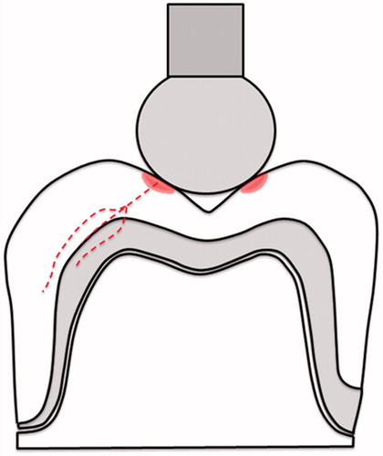 Figure 2. Application of the load aligned with the core-veneer interface, tangentially to the highest point of curvature between the buccal and the occlusal cusps. The dotted line shows three different crack pathways in the interface region; cohesive in the unsupported porcelain, cohesive in the core material or adhesive in the interface.