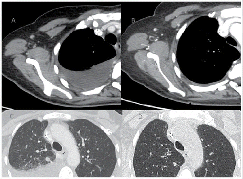 Figure 2. Stability of pathological axillary nodes (A, B) and lung metastases (C, D) from March 2009 until April 2014.